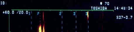 STUDIO DELLA FUNZIONE DIASTOLICA DEL VS PW Doppler TEMPORAL PROFILE M-mode color