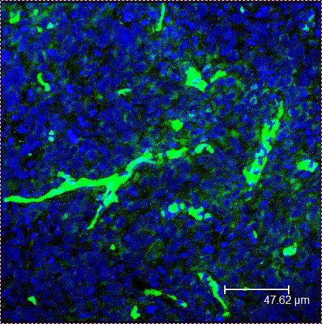 Modello sperimentale: linea cellulare di tumore umano