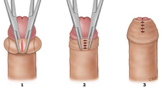 parafimosi