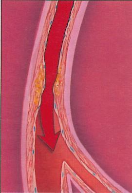 Ischemia cardiaca Una placca ateromasica nelle coronarie determina riduzione del flusso sanguigno al cuore.