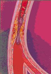 sintomo (ischemia silente).
