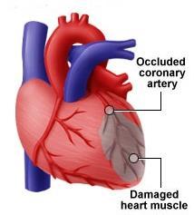 Infarto del miocardio (IMA) Occlusione di una coronaria necrosi del tessuto a valle, che diviene elettricamente e meccanicamente inerte.