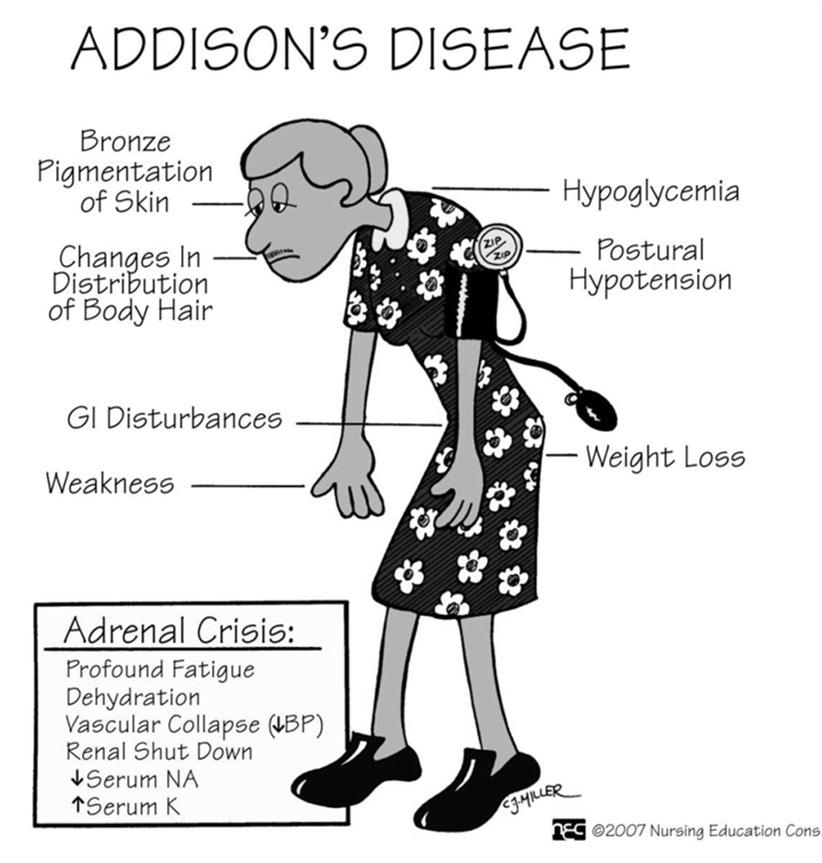 Addison) Insufficienza surrenalica secondaria (lesioni ipotalamo o