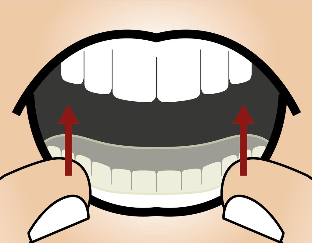 Estrarre il bite dalla bocca del paziente.