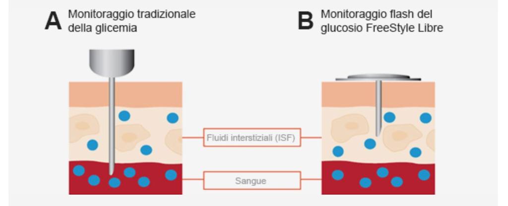 Monitoraggio del glucosio interstiziale Misura la concentrazione del glucosio nel liquido interstiziale sottocutaneo tramite un ago-sensore monouso Monitoraggio tradizionale della glicemia