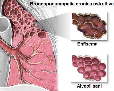 Broncopneumopatia cronica