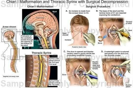 M. Chiari :