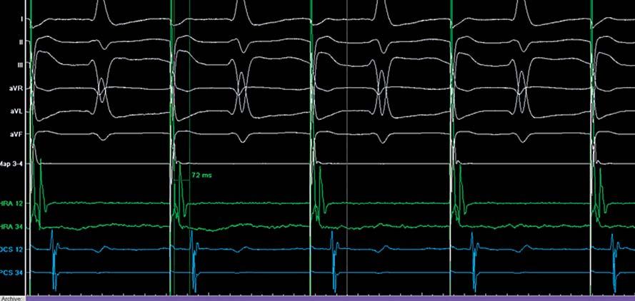 L intervallo di conduzione interatriale tra l attivazione dell atrio alto e l attivazione a livello del seno coronarico distale è uguale a ms.