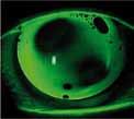 Case report dopo cheratoplastica perforante (KP) Astigmatismo elevato e accentuata formazione di scalini dell occhio destro.