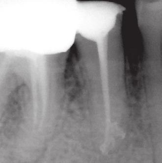pre-medicazione L isolamento del campo operatorio: utilizzo della diga e ricostruzioni pre-endodontiche Magnificazione La cavità d