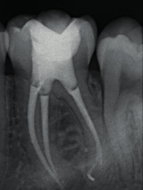 Parte pratica: Chiusura tridimensionale del canale* VI INCONTRO La ricostruzione post endodontica I riassorbimenti radicolari Sbiancamenti