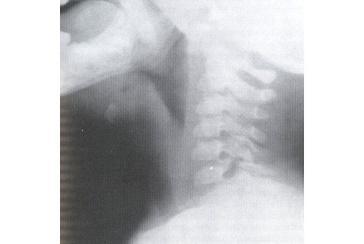 Radiografia Impiego: sospette cause di disfagia con evidente dislocazione di strutture anatomiche Basso costo