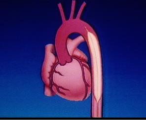Il palloncino viene posizionato in aorta discendente si