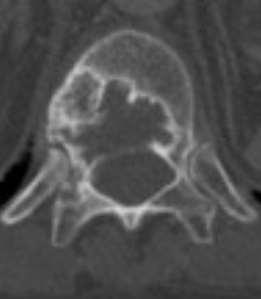 Per comparsa dolore di lieve entità (VAS:5) a livello dell estremità distale colonna dorsale si