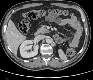 nodulo in prossimità dell arteria renale sx sospetto per