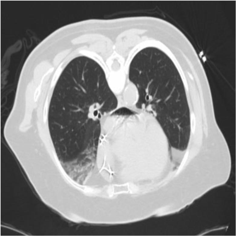 Complicazioni Fattori di rischio Aspergillosi angioinvasiva Lesioni cavitate Core biopsy vs fine-needle