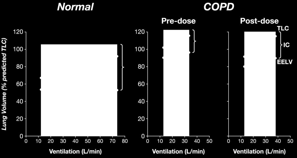 HYPERINFLATION IN COPD