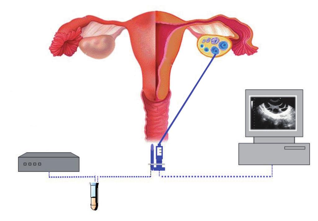 Fig. 3 - Schematizzazione del prelievo ecoguidato transvaginale di ovociti 1) sonda ecografica vaginale 2) ago di aspirazione 3) Falcon in cui viene raccolto il liquido follicolare, cioè il contenuto