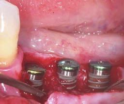 correzione di piccoli difetti peri-implantari Come manipolare tessuti duri e molli in caso di