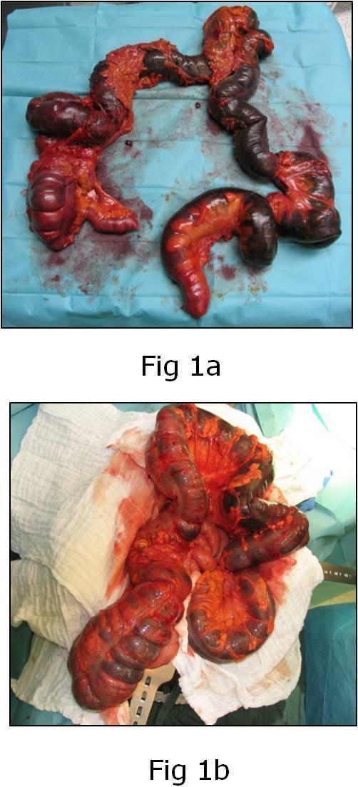 Patogenesi non ostruttiva Ischemia