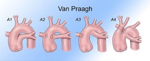 dello stesso. Figura 3 Classificazione secondo Van Praagh Le forme più frequenti sono rappresentate dal tipo 1/A1 e dal tipo A4. PREVALENZA 1,07 su 10.