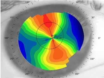 ottenere una accurata mappatura di quasi tutta la superficie corneale.