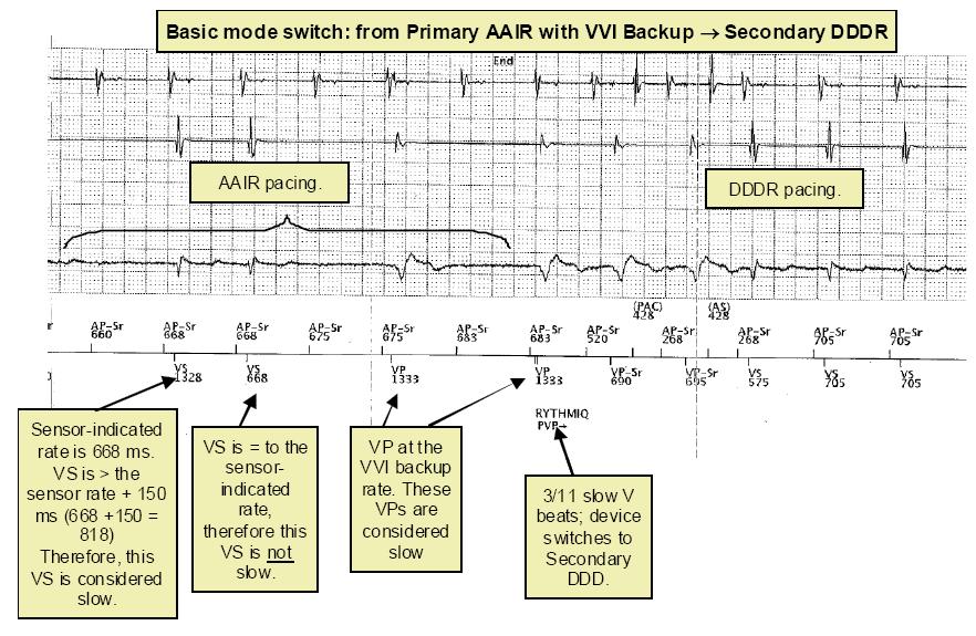 RhythmIQ (Boston) 20 Switch basale: in primis da AAI a VVI, poi da VVI a DDD Pacing AAI Pacing DDD-R La frequenza indicata dal sensore è 668ms.