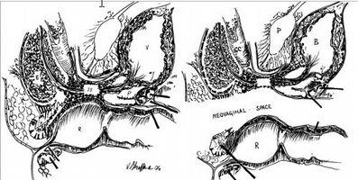 Fase Ricostruttiva Preparazione spazio prostato-rettale dove alloggiare la neovagina Il piano di dissezione