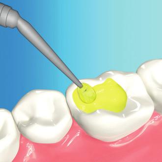 li a base di ammidi che permettono la penetrazione immediata dell adesivo nella dentina, azzerando i tempi di attesa prima di continuare la procedura operativa.
