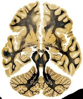 Il peduncolo cerebellare medio è il più grande dei tre ed è