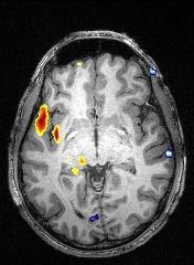 Risultati possibili: Non si registrano punte sull EEG durante l acquisizione Si registrano punte EEG, ma non ci