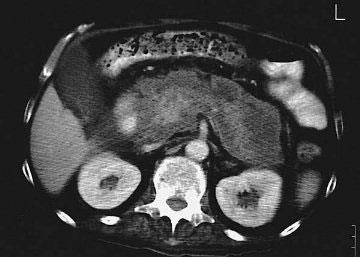 PANCREATITE ACUTA Estensione e prevalenza delle singole alterazioni morfologiche