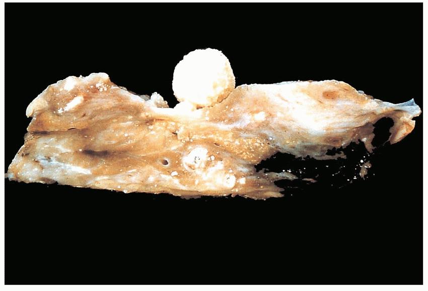 PANCREATITE CRONICA Alterazioni morfologiche Macroscopicamente il pancreas si presenta di consistenza aumentata, con foci di calcificazione