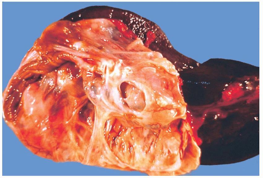 NEOPLASIA CISTICA