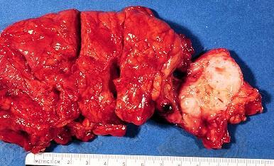 ADENOCARCINOMA DUTTALE