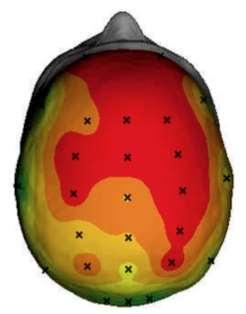 EEG IN ADHD I pattern neurofisiologici specifici: eccesso di attività lenta Bibliografia: Mann, Lubar, Zimmerman, Miller & Muenchen, 1992; Matsuura et al.