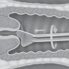 4 PREPARAZIONE DEI CAMPIONI GINECOLOGICI Prelievo endocervicale del campione ginecologico con un dispositivo del tipo brush/spatola Istruzioni per il medico relative al