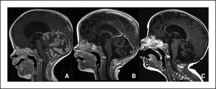 Caratteri clinico-biologici (medulloblastoma) Insorgenza nei bambini Localizzazione cerebellare (mediale) Espressione di markers neuronali e gliali Aspetto indifferenziato Derivazione «embrionale»