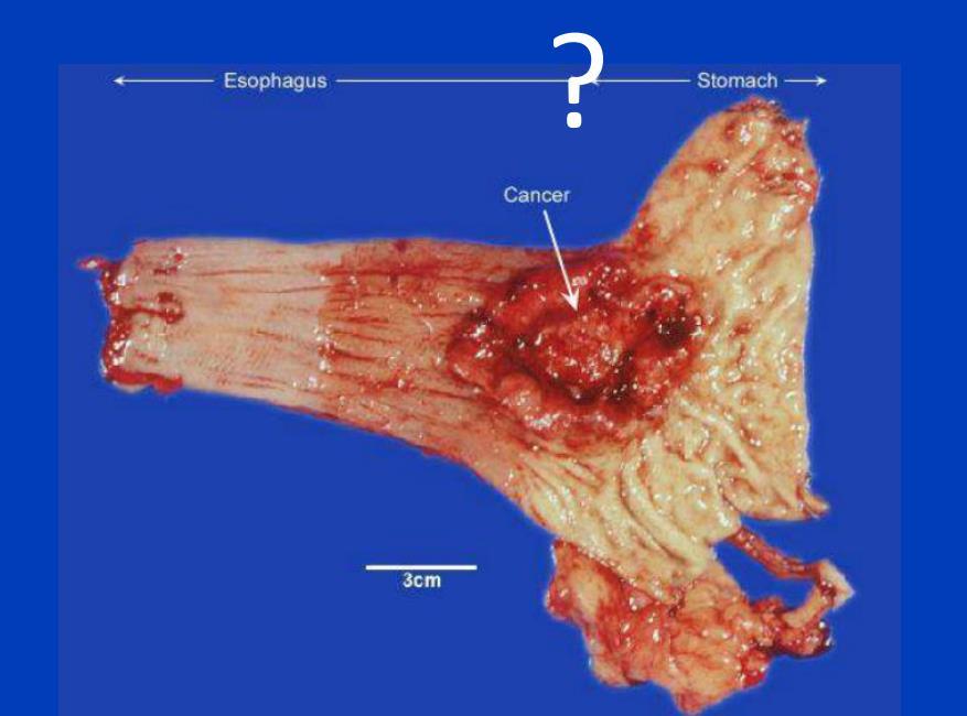 CA DEL CARDIAS SIEWERT III Anche se la classificazione secondo Siewert è molto utile nella definizione di una strategia globale di queste neoplasie, la decisione