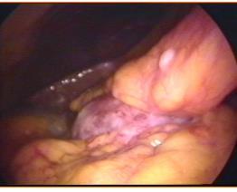 peritoneale e nei pazienti con CA localmente avanzato e/o con N+ > 1 cm - 2) Dopo terapia neo-adiuvante come il