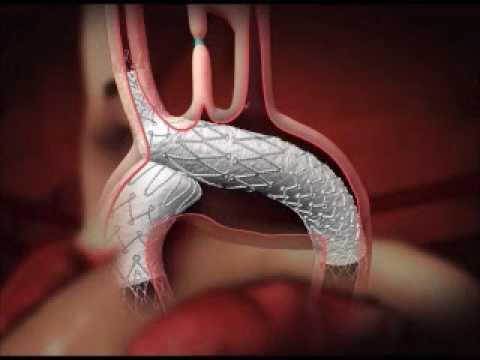 transcatetere Stenting aorta