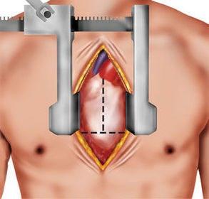 Cardiochirurgia tradizionale