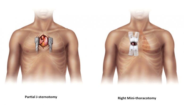 Cardiochirurgia MINI-invasiva