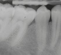 Di suino Straumann Emdogain Amelogenine Emdogain nella rigenerazione orale La parodontite è associata a perdita del tessuto di sostegno dei denti ed è irreversibile, costituendo la causa principale