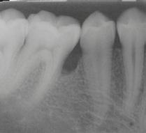 Studi clinici a lungo termine hanno dimostrato che Emdogain è in grado di salvare i denti e trattare la recessione gengivale in modo efficace.