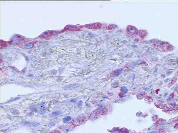 Ibridazione in situ Ibridazione in situ per RNA del virus Epstein- Barr (EBER) in