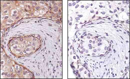 Marcatura marrone dei nuclei delle cellule infette EBER.