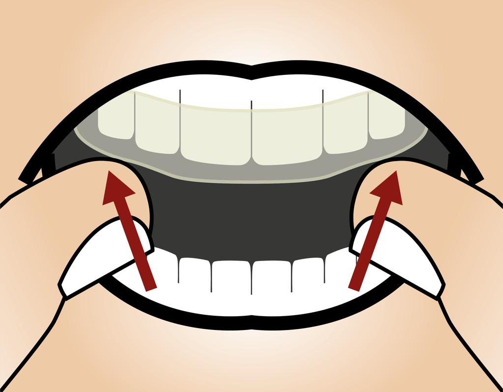 L'UTILIZZO DEL SUO BITE TERAPEUTICO OPTIMOTION Utilizzo del bite terapeutico Inserire completamente il bite nella bocca.