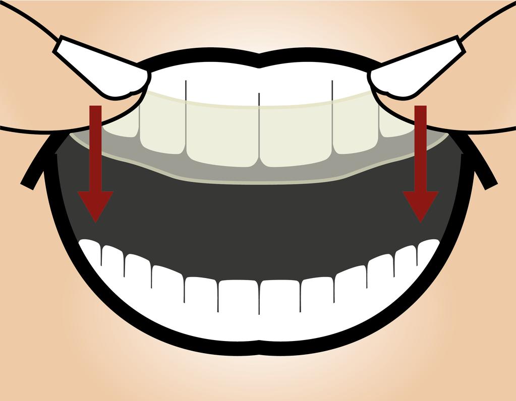Rimuovere il bite terapeutico Il bite terapeutico dovrebbe essere rimosso dall arcata dentale esercitando una leggera forza.