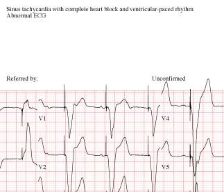 Interpretazione avanzata dei ritmi cardiaci mediante il programma Marquette* 12SL, in grado di individuare ed analizzare il ritmo sottostante, aumentando pertanto le capacità di supporto decisionale